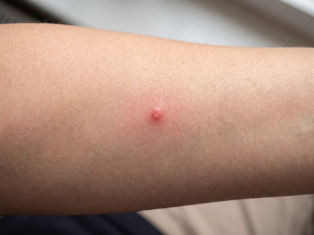 Close-up of a fresh robber fly bite on skin showing a single small red puncture point with mild swelling and no rash pattern